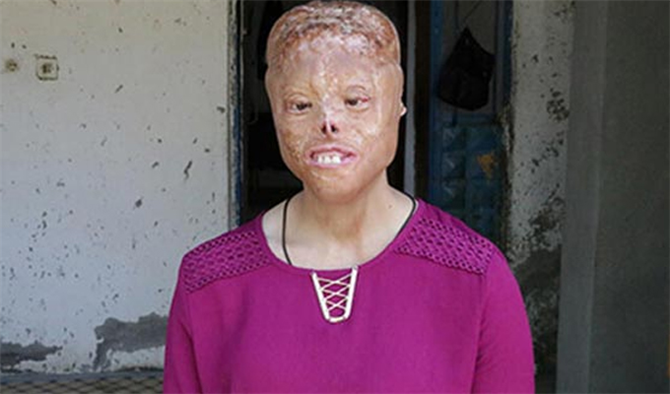 Kahramanmaraş'ta 1.5 aylıkken yüzü yanan Leyla 20 yaşında yardım bekliyor