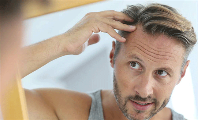Erkeklerin Saçları Neden Dökülür? Saç Dökülme Tedavisi Nasıl Yapılır?