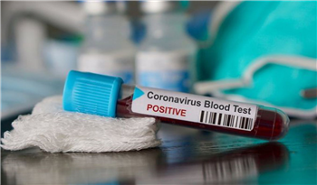 4 Ekim Günlük koronavirüs tablosu. 4 Ekim 2020 günlük koronavirüs tablosu açıklandı.