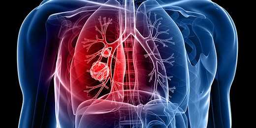 17 Kasım Dünya Akciğer Kanseri Günü